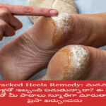 Cracked Heels Remedy: Are you suffering from cracked heels? This tree milk will make your feet smooth.. It won’t cost a penny.